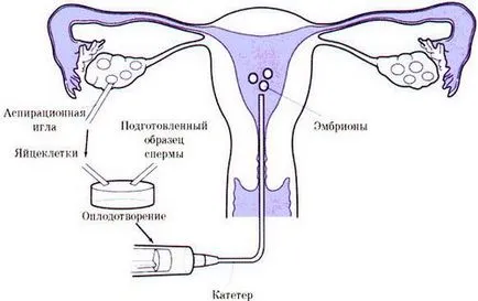 Teherbe egy gyermek keresztül IVF koncepció