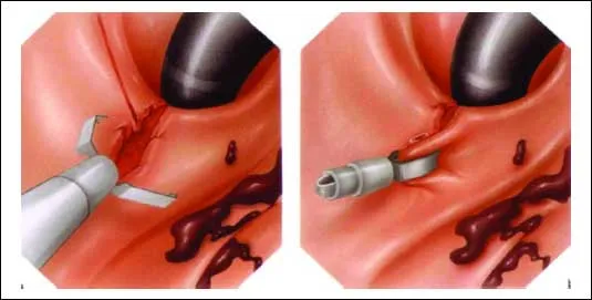 hemoragii gastro-duodenal sau ulcer gastric sângerare