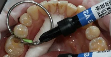 Течност за пълнене за зъби, че такива предимства и недостатъци, ревюта