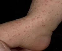 Acrodermatitis - причини, симптоми, диагностика и лечение