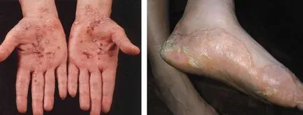 Acrodermatitis видове болести, симптоми и лечението