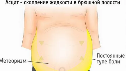 ascita abdominale tratament remedii populare