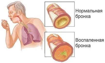 Atrófiás bronchitis okok és a kezelés