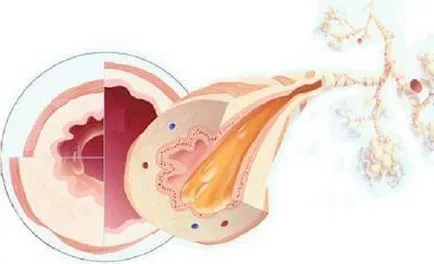 Atrofia bronhiilor - cauze, simptome, tratament