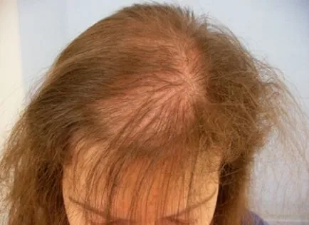 alopeciei androgene la femei și bărbați, tratamentul și prevenirea
