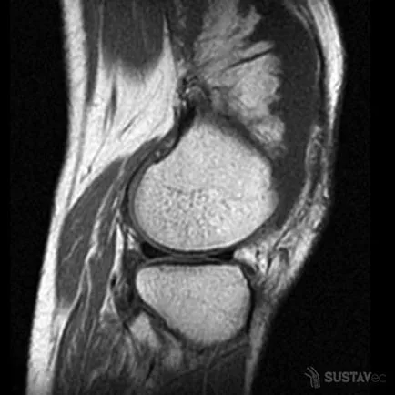 Anatomy of a térdízület és szalagok férfi táska képekben (fotók és videó), MRI betegségek