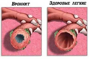 Бронхит причини, лечение и препоръки за болки в гърдите