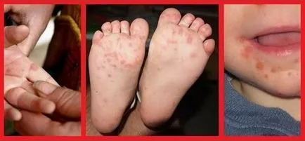 Betegség „kéz-láb-száj”, hogy ne elkapni enterovirus fertőzés - Könyvtár - Dr. Komarovsky
