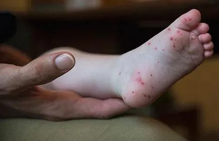 Betegség „kéz-láb-száj”, hogy ne elkapni enterovirus fertőzés - Könyvtár - Dr. Komarovsky