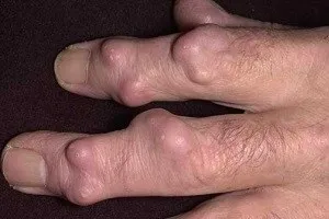Шишки на суглобах пальців рук причини, симптоми, лікування (пальців) Шишки на суглобах пальців рук причини, симптоми, лікування