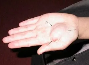 Шишка на долоні під шкірою що це таке (відразу звернутися до лікаря) Шишка на долоні під шкірою що це таке