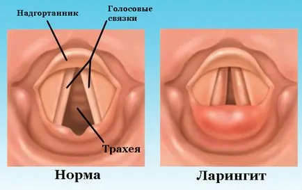 Than за лечение на ларингит при децата - най-доброто лекарство, сиропи и подготовката за бебето