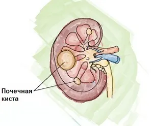 Какво да направя, за да реши киста на лечение на бъбреците при жените и мъжете