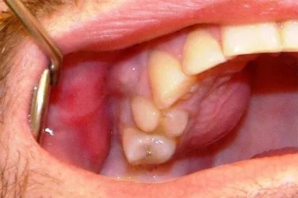 Ce este un simptom maxilarului abcesul si tratamentul parodontitei
