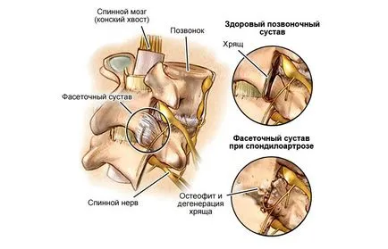 Deformáló spondylosis az ágyéki gerinc, a tünetek és a kezelés