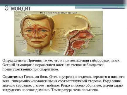 Tratamentul Ethmoiditis și simptome la adulți și copii, în casa de remedii populare,