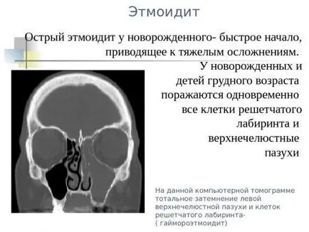 Tratamentul Ethmoiditis și simptome la adulți și copii, în casa de remedii populare,