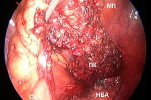 Colon Cancer Pictures