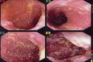 Colon Cancer Pictures