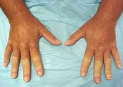 Склеродермия - причини, симптоми, діагностика та лікування