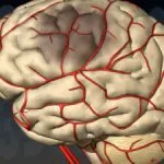 Hipoplazia arterei cerebrale - simptome și tratament