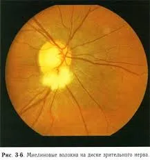 Очен нерв хипоплазия - отговори и съвети на вашите въпроси