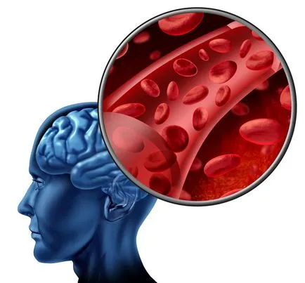 Accident vascular cerebral ischemic partea stanga - efecte, tratament, recuperare, prognoza, de îngrijire cardio