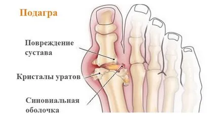 Как да се отървем от употреба подагра при лечението на ALMAG-01!