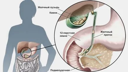 Hogyan és miért a kövek képződnek az emberi testben