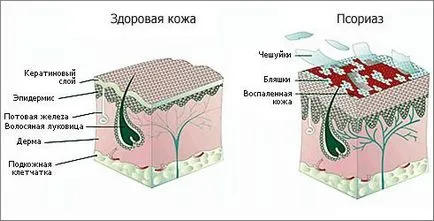 Як розпізнати псоріаз - перші ознаки псоріазу