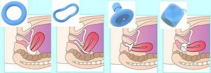 Hogyan tegye a pesszárium terhesség alatt (gyűrűnek a méhnyak), miért van rá szükség, stb