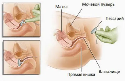 Hogyan tegye a pesszárium terhesség alatt (gyűrűnek a méhnyak), miért van rá szükség, stb