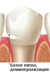 Cariile - cauze, simptome, tratament si prevenirea cariilor dentare, carte de sănătate