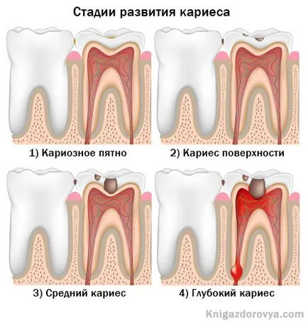 A fogszuvasodás - okai, tünetei, kezelése és megelőzése fogszuvasodás, egészségügyi könyv