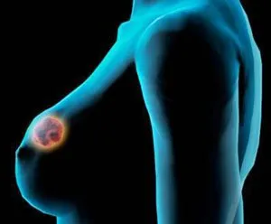 Киста в гърдата - тя е и как тя се различава от фиброаденом
