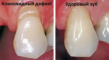 В клиновиден дефект - причини, симптоми, лечение на венците рецесия - Стоматологичен портал