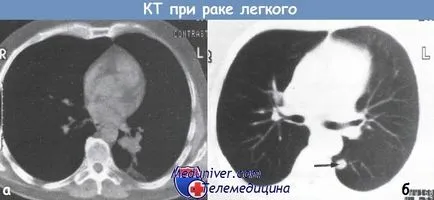 Tomografia computerizata (CT) în diagnosticul de stadiul de cancer