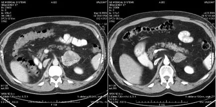 Adrenal tomografie computerizata (CT) - cum este efectuată, de pregătire