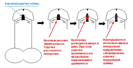 Къса юздичка препуциума описание на проблема и неговото отстраняване