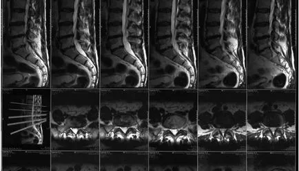 A komputertomográfia a gerinc