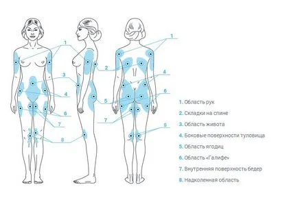 Cryolipolysis előtt és a beavatkozás után, a gép Zeltiq (zeltik) és analógjai otthoni