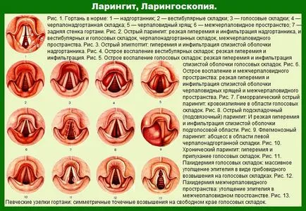 Ларингит при кърмачета