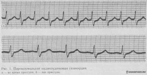 Kezelése rohamokban jelentkező szupraventrikuláris tachycardia