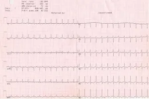 Kezelése rohamokban jelentkező szupraventrikuláris tachycardia