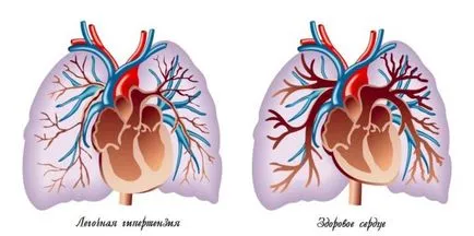 Pulmonális hipertónia okok és a tünetek, a kezelésére és megelőzésére betegségek