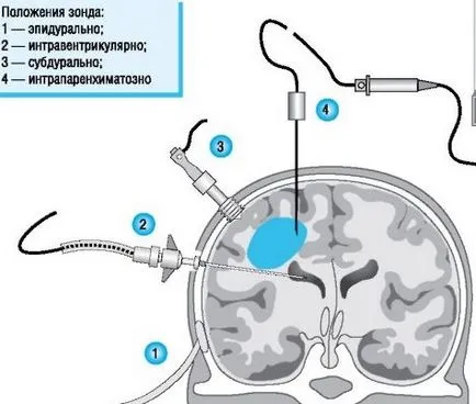 Tratamentul cresterea presiunii intracraniene, presiunii intracraniene la copii