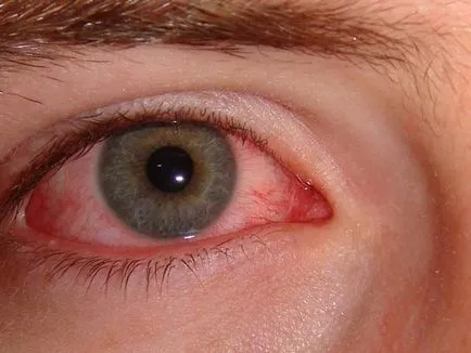 pungile de sub ochi cauzele posibile de tratament