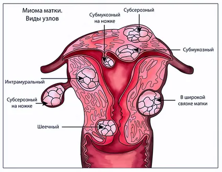 fibrom uterin tratamentul populare remedii, diagnosticare și recomandări