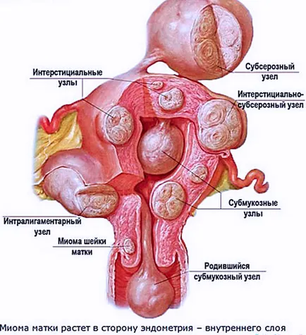 fibrom uterin tratamentul populare remedii, diagnosticare și recomandări