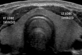 ултразвук щитовидната жлеза Норма